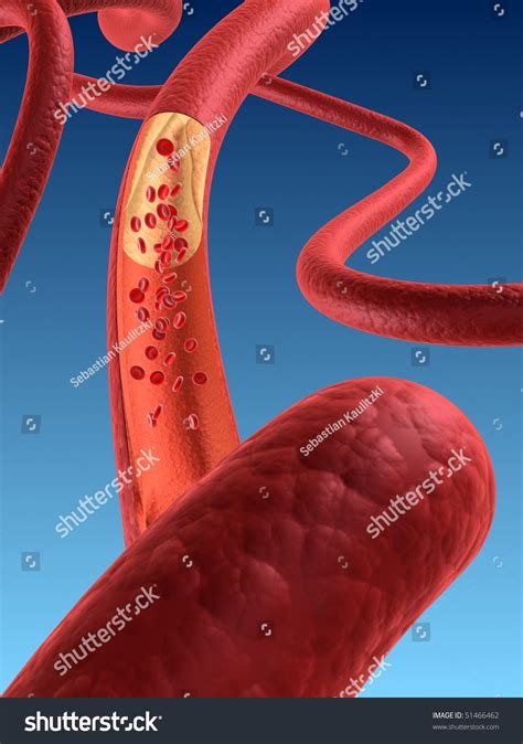 Arteriosklerosis .